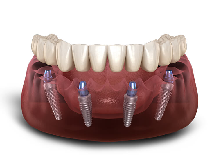 All-On-4® Dental Implants