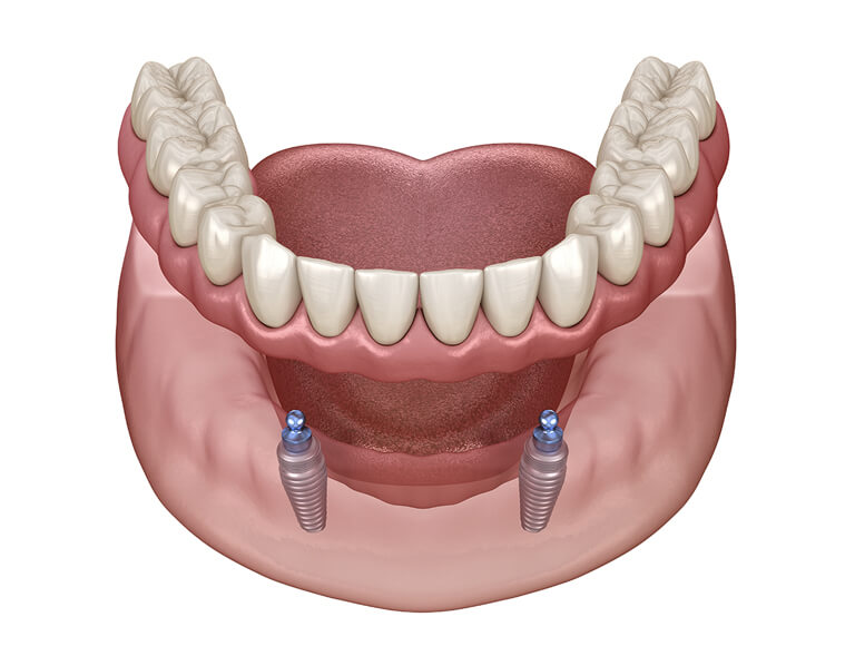 Acrylic Overdentures