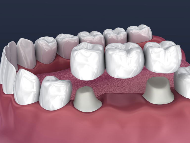 Advantages of Dental Bridges