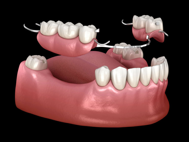 What are Dentures & Partials