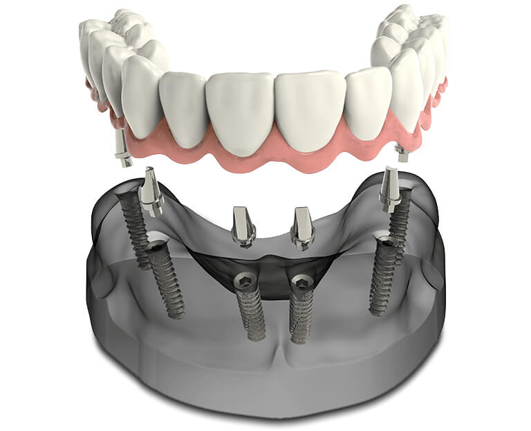 Benefits of Teeth-In-A-Day