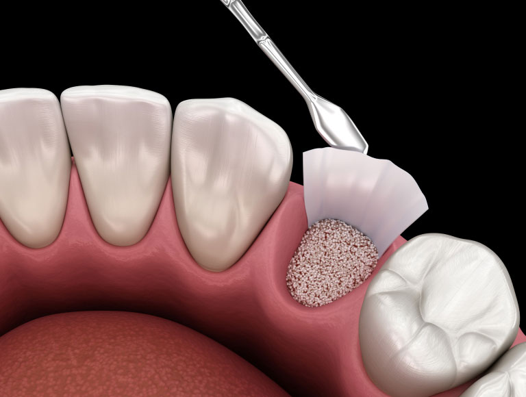 Understanding Ridge Augmentation