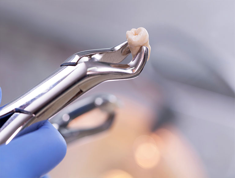 Our Tooth Extraction Process