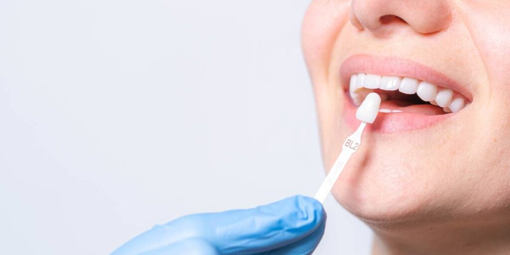 Featured image for What Problems Can Veneers Solve?