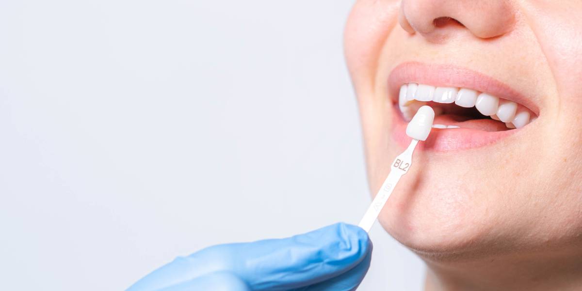 Featured image for What Problems Can Veneers Solve?
