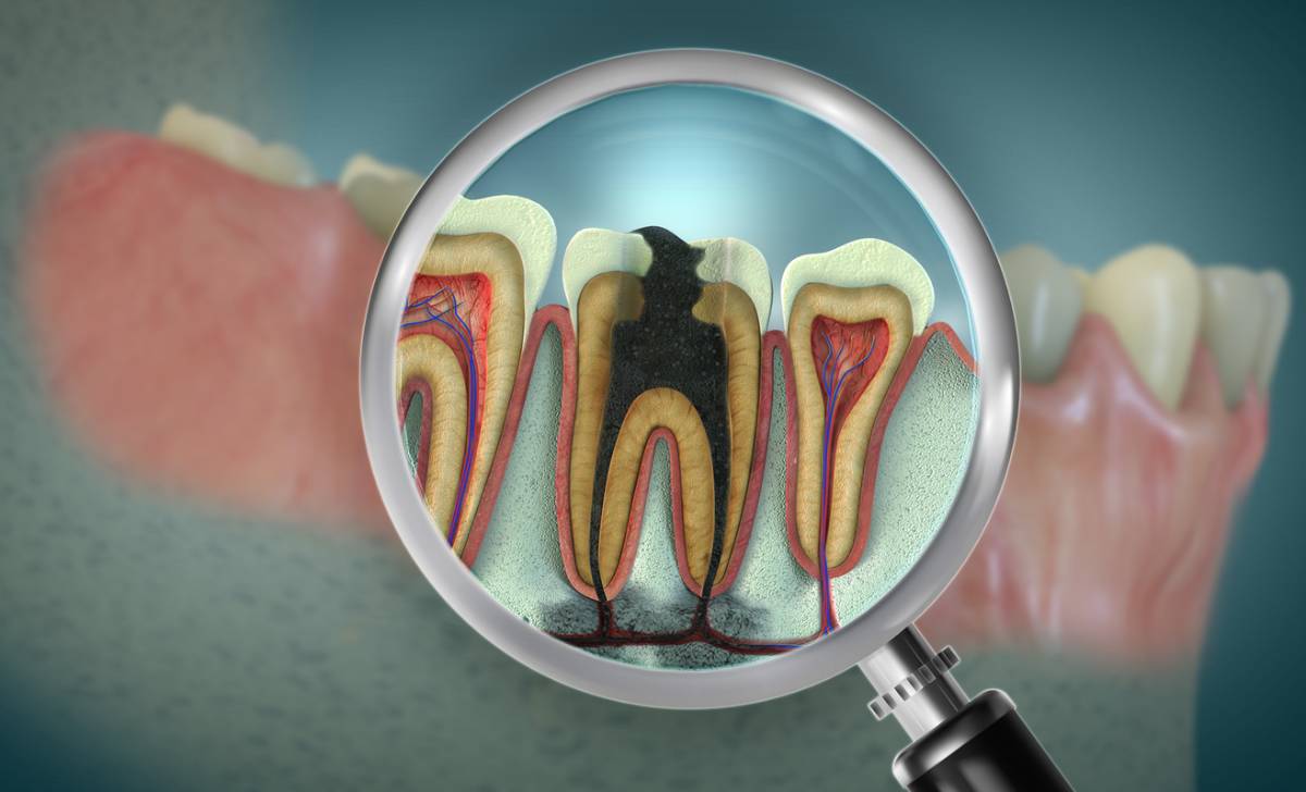 Featured image for How to Prepare for Root Canal Treatment