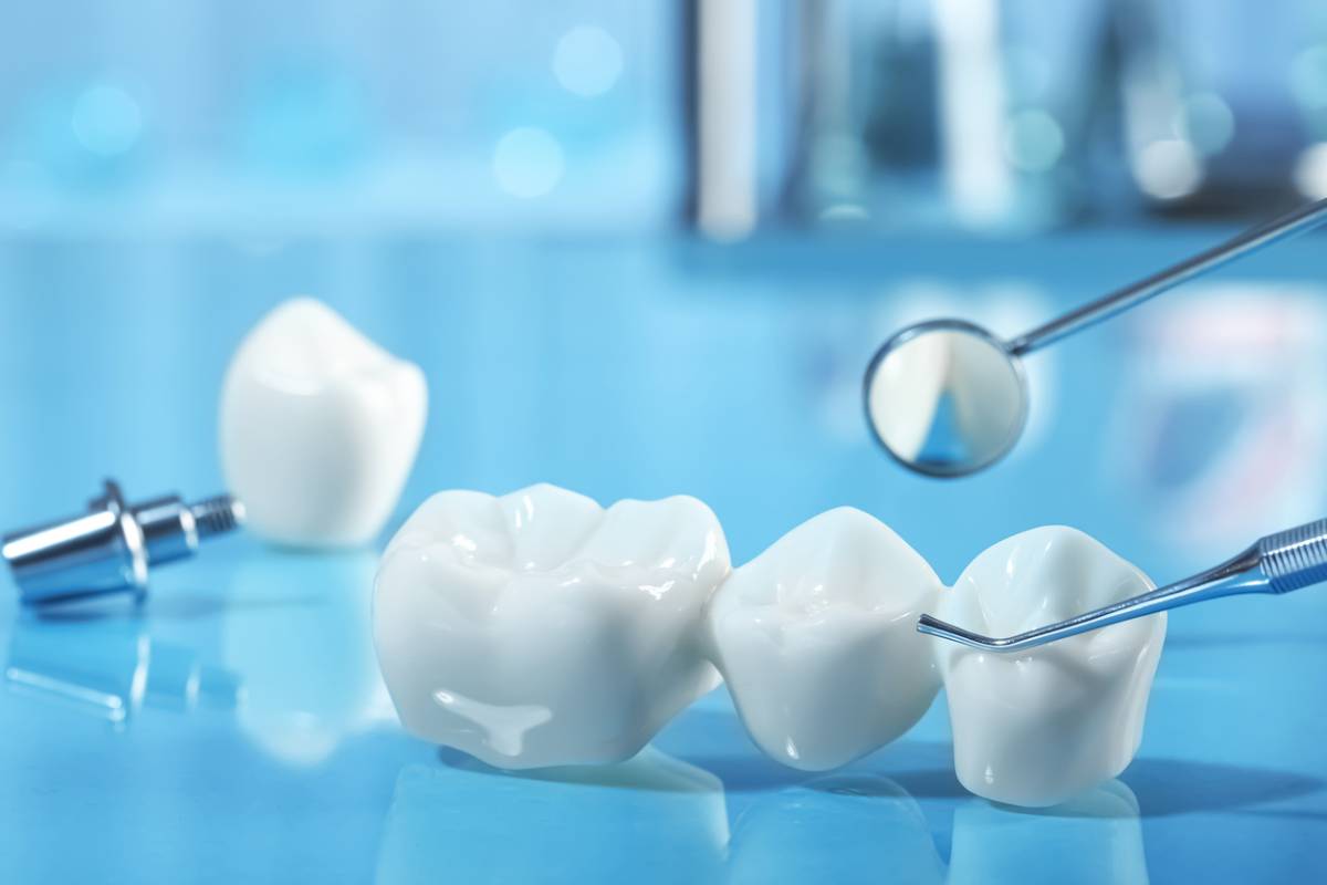 Featured image for How Long Does a Dental Bridge Last?