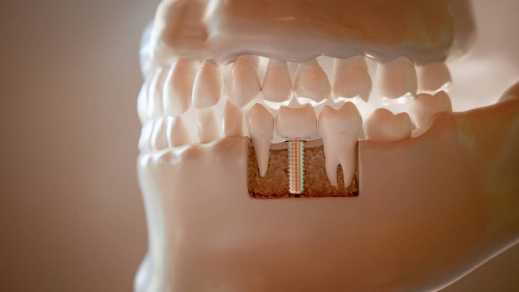 featured image for blog on main types of dental implants